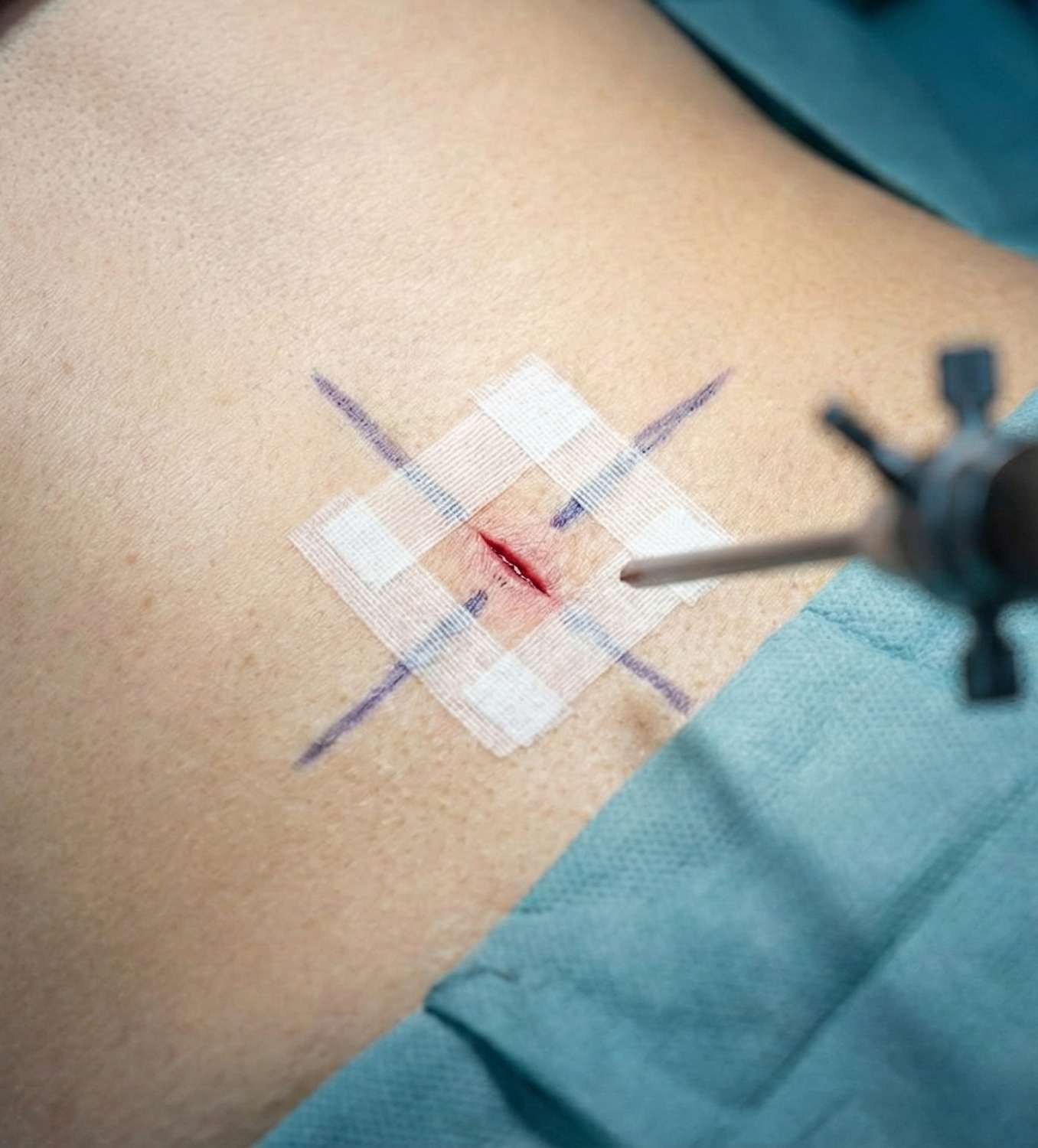 Kapalı Bel Fıtığı Ameliyatı - Tedavi görseli